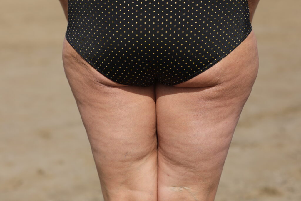 fat female body with cellulite fatty hips and but 2024 10 18 17 25 54 utc